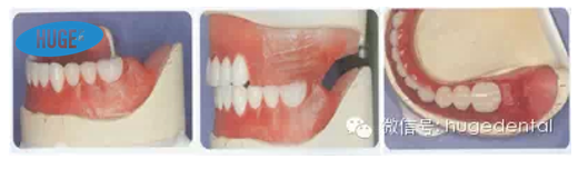 沪鸽护嵴舒全口义齿排牙与调方法