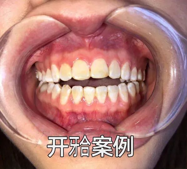 学会这五点，让你实现牙齿畸形早预防！